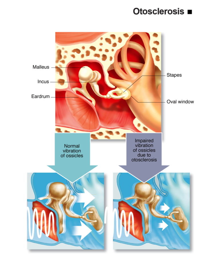 Infografis otosclerosis